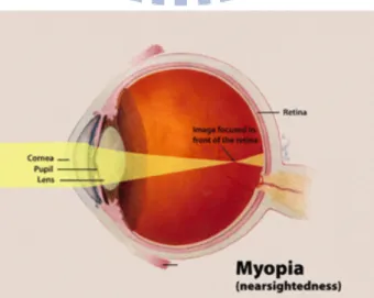 Figure 1: The phenomenon of Myopia 