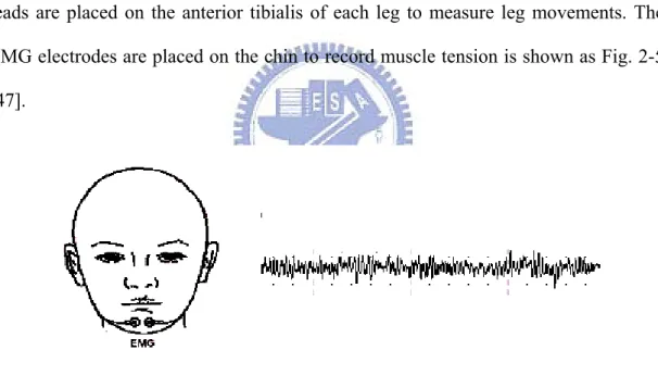 Fig. 2-5: The EMG electrodes position and recorded pattern of chin muscle  tension [47]