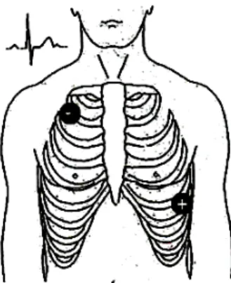 Figure 2.7: A single modified ECG Lead II use torso electrode placement[18]. 