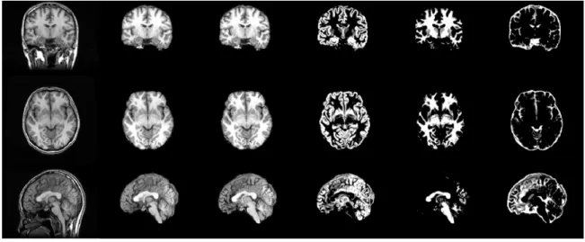Figure 2.3: Effect of the procedure of tissue segmentation. This figure shows the effect from different tissue segmentation procedures in three different views of MRI brain  im-age