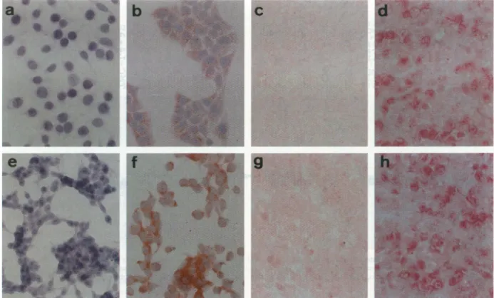 Figure 2. Immunostaining for LMP1 expression in LMP1-expressing gastric carcinoma cells