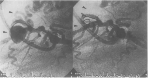Fig.  1.  S a c c u l a r  t y p e   coronary  a r t e r y   a n e u r y s m   is in l a t e r a l  projection
