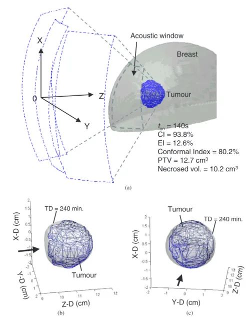 Figure 13. One practical treatment case where the PTV is located in female breast: (a) geometrical relation between body portion and the heating system, and (b), (c) the PTVs and isosurfaces of TD = 240 min from different views