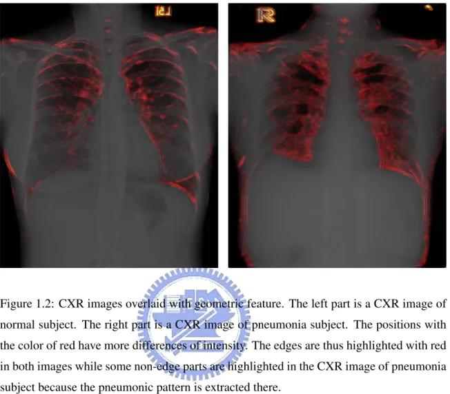 Figure 1.2: CXR images overlaid with geometric feature. The left part is a CXR image of normal subject