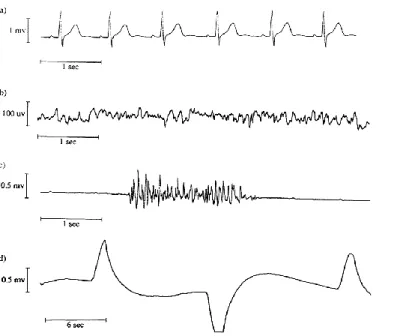 Fig. 1.1 Waveforms of the biopotentials: (a) ECG (b) EEG (c) EMG (d) EOG [1] 