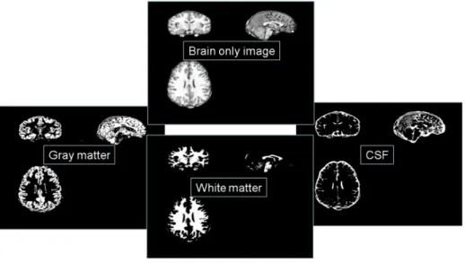 Figure 2.3: The segmentation. The figure shows an example of segmentation result. A brain only image is segmented into different tissue classes which are gray matter (GM) image, white matter (WM) image and cerebrospinal fluid (CSF) image.