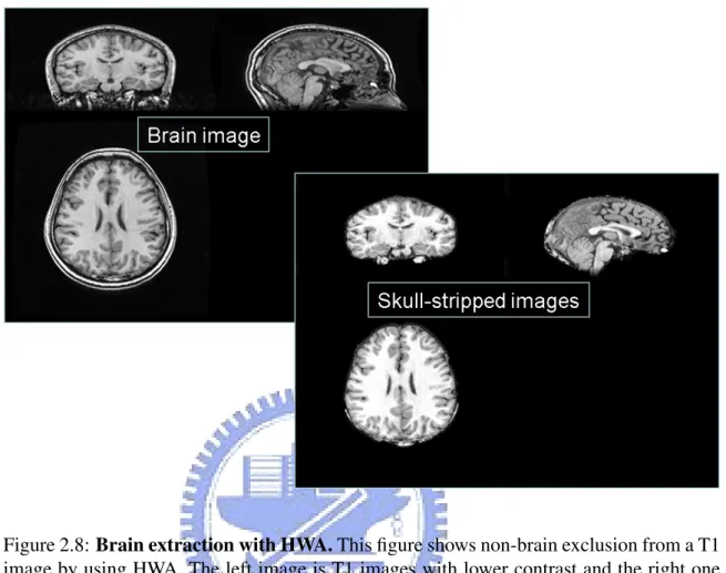 Figure 2.8: Brain extraction with HWA. This figure shows non-brain exclusion from a T1 image by using HWA