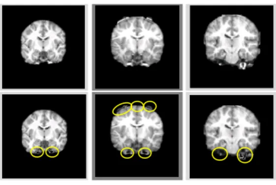 Fig. 6. The result of deleting non-WM voxels with gray values higher than estimated WM