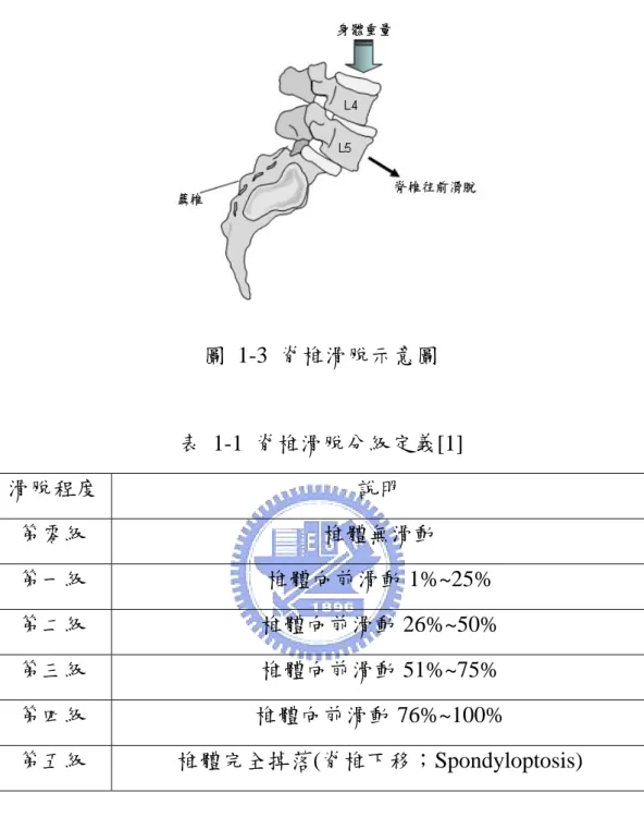 圖 1-3 脊椎滑脫示意圖  表 1-1 脊椎滑脫分級定義[1]  滑脫程度  說明  第零級  椎體無滑動  第一級  椎體向前滑動 1%~25%  第二級  椎體向前滑動 26%~50%  第三級  椎體向前滑動 51%~75%  第四級  椎體向前滑動 76%~100%  第五級  椎體完全掉落(脊椎下移；Spondyloptosis) 