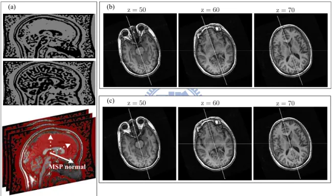 Figure 3.3: Brain MSP estimation and reﬁnement. (a) TDOG image is more planarly distributed nearby the MSP (top), compared to other regions (middle)
