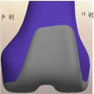 圖 2-23、人工膝關節置換後模型 