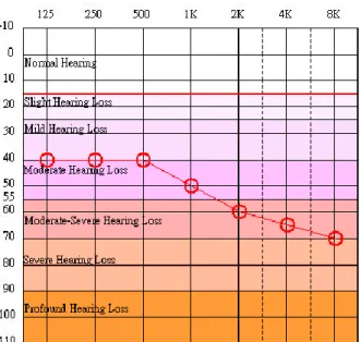 Figure 2-2 Audiogram of typical hearing loss 