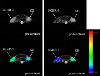 圖  18.  將接腫  SKBR-3 及  KB 腫瘤小鼠以尾部靜脈注射 CLIO-Herceptin  一小時後利用  3.0  T MRI  進行造影所得之影像，並且利用光學影像軟體  Kodak MI  將灰階影像套上色譜。 