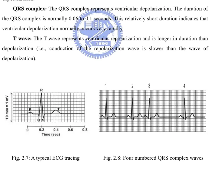 Fig. 2.7: A typical ECG tracing  Fig. 2.8: Four numbered QRS complex waves 