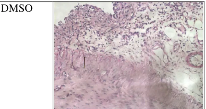 Fig. 6: The border of mesentery thickened  with neovasclarization after bleach 