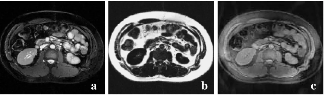 Figure 2.   Water-only (a) and fat-only (b) SSFP images obtained using the Dixon  method from the +80 Hz in-phase and the –80 Hz out-of-phase images in Fig.3