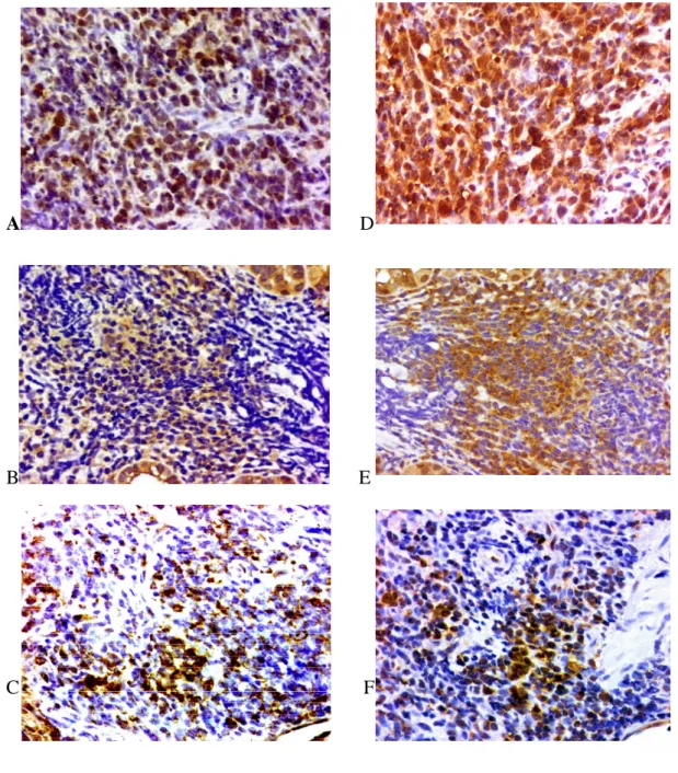 Fig. 1. BCL10 and NF-B protein expression in high-grade gastric MALT  lymphoma.    (A,B,C): BCL10