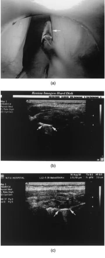 Fig. 3. (a) The identification of the structure of the vocal fold cover was performed in the B-scan by using the metallic instrument contacting the right vocal fold free margin as a contrast (arrow)