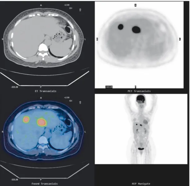 Fig. 1 Rendering F-18 FDG PET/CT display. The transaxial views of CT images (upper left) and corresponding PET images (upper right) fused to the PET/CT images (lower left) are displayed