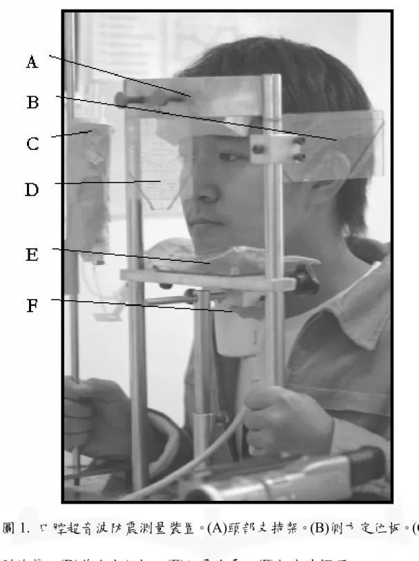圖 1.  口腔超音波防震測量裝置。(A)頭部支持架。(B)側方定位板。(C) 引流管。(D)前方定位板。(E)防震水囊。(F)超音波探頭。 