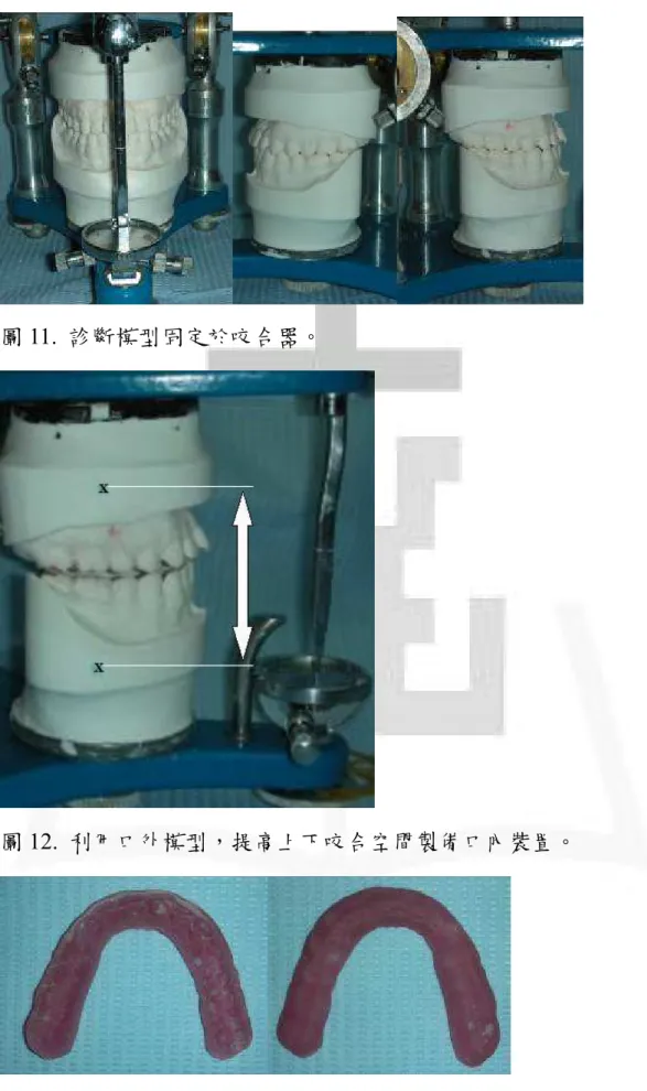 圖 11.  診斷模型固定於咬合器。 