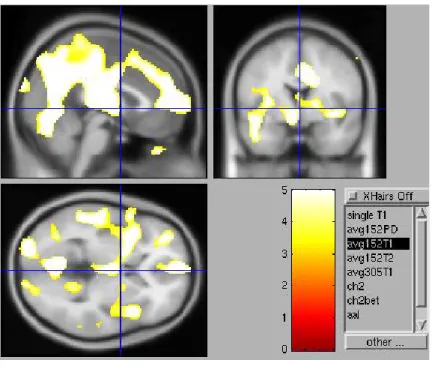 Figure 1. Regional CBF difference between PD and controls. (A). rCBF in controls  higher than PD