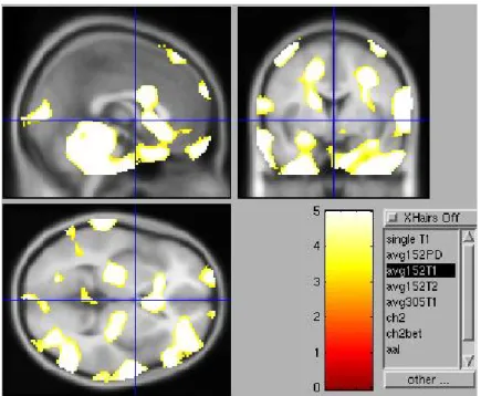 Figure 2. ROC by SVM method. (A) use previously 51 cases to make model and  plot ROC figure