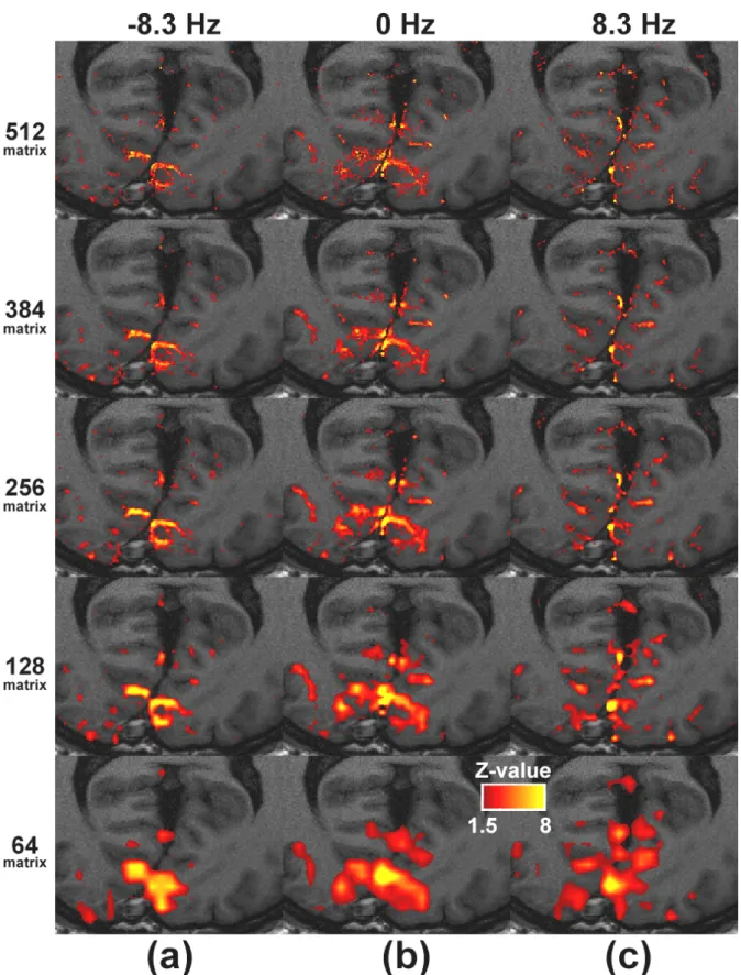 Figure 1. Activation maps (colored) overlaid on high resolution transaxial anatomical T1-weighted  images across the primary visual cortex