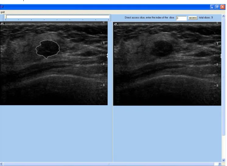 圖 V-A-7：多張影像處理後的結果。左上角的拉 Bar 可讓使用者手動 play 整個腫瘤邊界的變化 過程。 