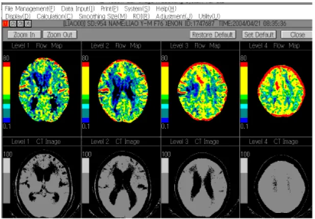 Fig. 2 Xenon CT measurement of cerebral blood flow 
