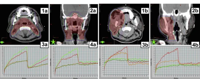 Figure 3 The axial (1a, 1b) and coronal (2a, 2b) isodose and time activity curves on quantitative salivary scintigraphy of the four major salivary glands prior to intensity- intensity-modulated radiotherapy (IMRT) (3a, 3b) and 12 months post-IMRT (4a, 4b) 