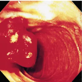 Figure 2. Microscopic appearance of a biopsy from the lesion in Figure 1 revealing septated yeast (arrow) inside  his-tiocytes (Gomori-methenamine silver stain; orig