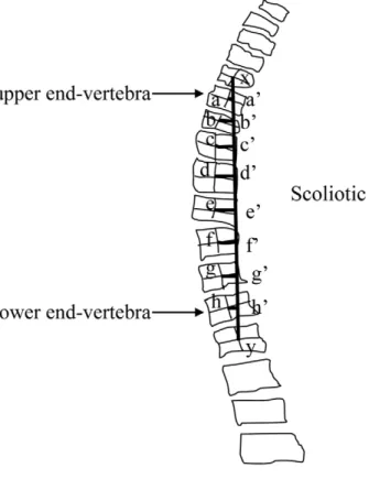 Fig 2. Scoliotic index for mea- mea-suring scoliosis severity.