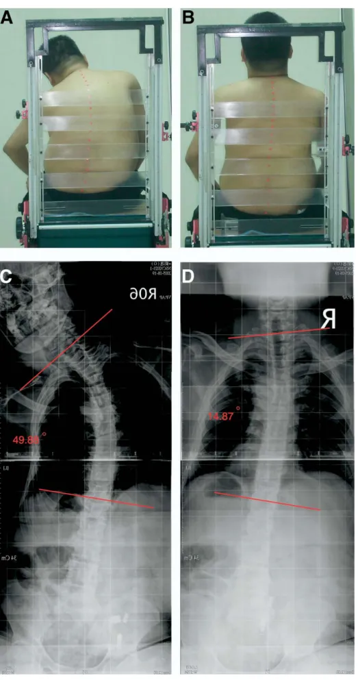 Fig 3. Posterior photographs of a sub- sub-ject with a complete C5 lesion (A) without and (B) with LTS