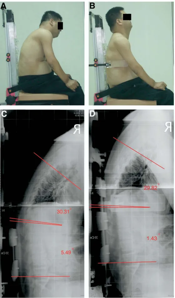 Fig 5. Lateral photographs of a subject with a complete C5  le-sion (A) without and (B) with LTS