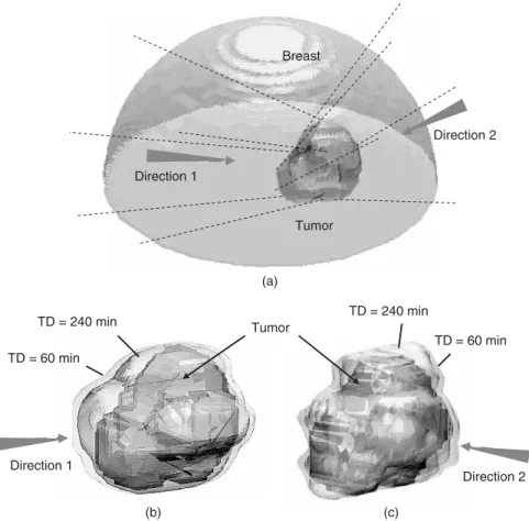 Figure 8. One practical treatment case of an irregular tumor located in female breast: (a) geometrical relation between breast and tumor; (b) and (c) surface views of PTV (pointed out by arrows) and TD ¼ 60 and 240 min iso-surfaces (pointed out by lines) a