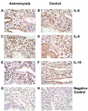 Figure 1. Immunohistochemical study of IL-6 (A, B), IL-8 (C, D) and IL-10 (E, F) in eutopic  endometrium in women with and without adenomyosis
