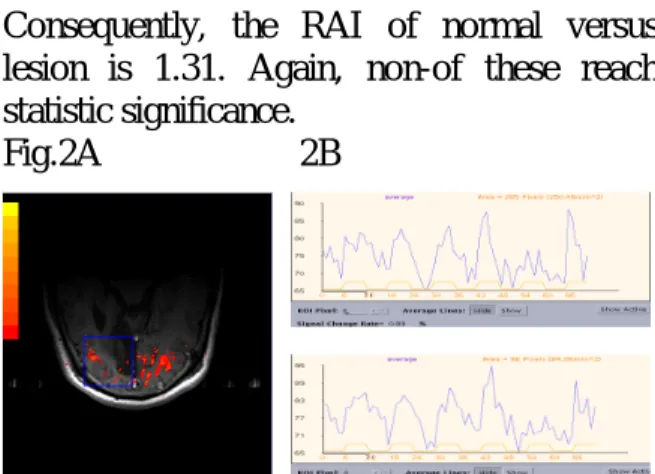 Fig  2A  Functional  images  with  activated pixels  displayed  against  on  a  TIWI  structure image