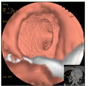 Figure 5. Virtual cardioscopy in a patient with a residual atrial septal defect.