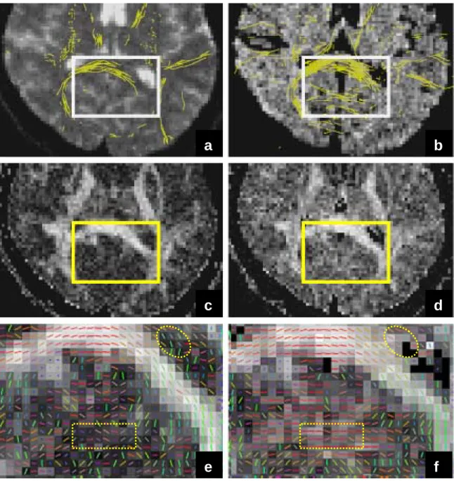 Figure 2.    The posterior aspects of the same image slice as in Fig.1.    Images represent white  matter tracts superimposed on the b = 0 images using the EZ-tracing algorithm (Figs.2a and  2b; top row), the FA maps in gray scale (Figs.2c and 2d; middle r