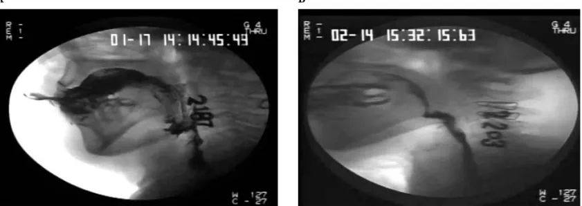 Fig. 1 (A) Video fluoroscopic swallowing study (VFSS) on day 3 of the hospitalization shows markedly abnormal bolus holding, piecemeal swallowing and abnormal oral mucosa coating; (B) Follow-up VFSS at about 4 weeks shows near normal swallowing except mild