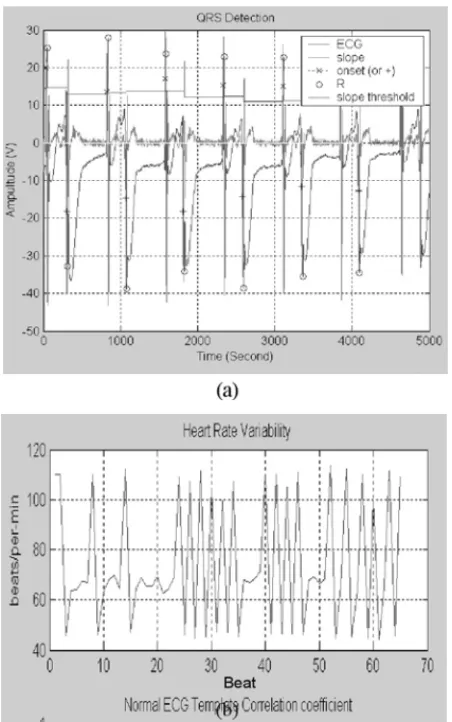 Fig 2. (a) The results of R wave detection, (b) The curve of HRV of Record 119 in MIT-BIH database.