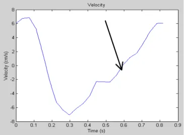Figure 1. Velocity  of  CSF  flow  in  the  aqueduct  of  Sylvius  plotted  versus  time  in  one  cardiac  cycle  for  a  healthy  young  subject  (male,  26  yo)  where  the  notch  was  obviously present.