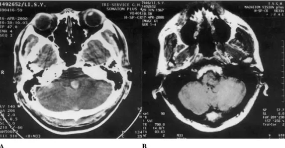 Fig. 1. A Preoperation cranial computed tomographyshows a hematoma in the left posterior pons