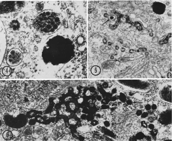 FIGURE 4 Oblique sections through premelanosomes with advanced melanization . The internal small vesicles are all filled with reaction product 