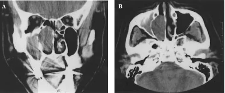 Figure 1. (A) Coronal section and (B) horizontal section computerized tomography scans show a large soft tissue mass in the right nasal cavity with bony erosion of the inferior and middle turbinate and medial wall of the maxillary sinus
