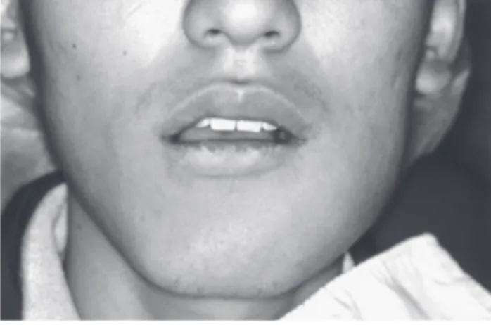 Figure 3. Radiography reveals incomplete root formation with an open apex and radiolucency in the periapical area.