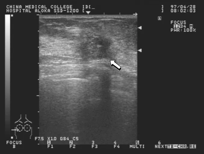 Fig. 1.  A 736 × 556 digital image is captured from the sonographic scanner. Note that there are 58 ×  58 = 3364 pixels in a 1cm × 1cm rectangle
