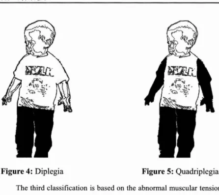 Figure  4:  Diplegia  Figure 5: Quadriplegia 