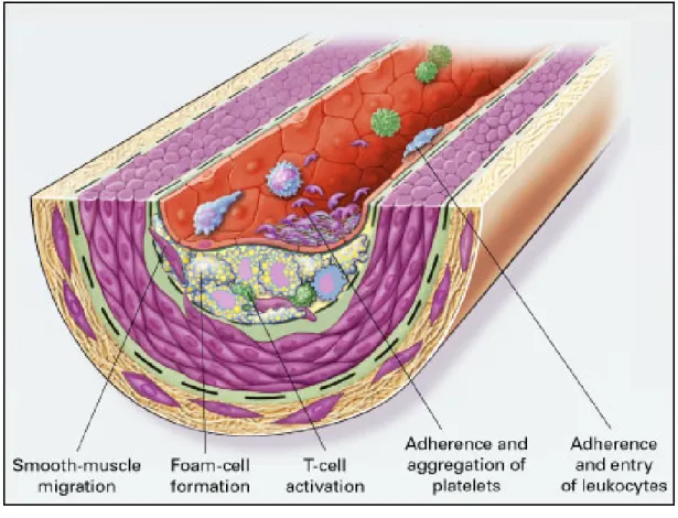Fig. 2-2. Fatty-streak formation in atherosclerosis (Ross, 1999). 